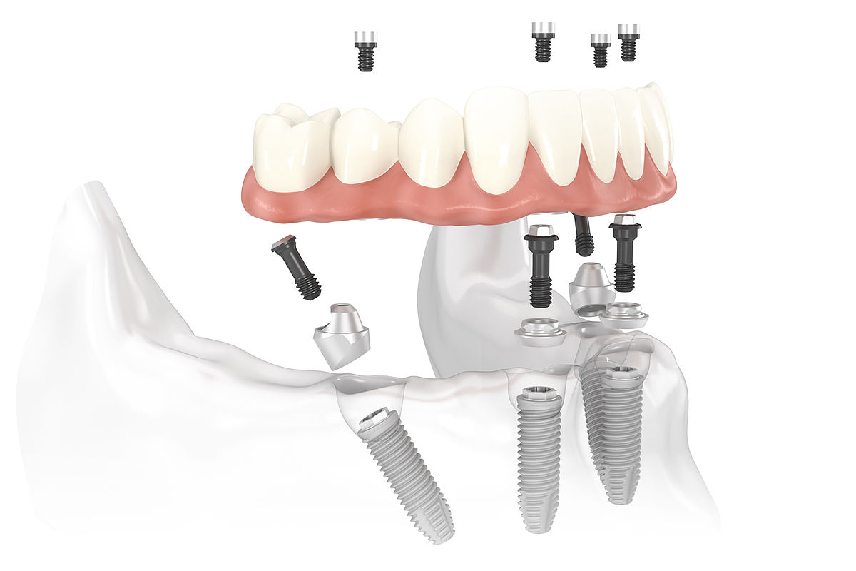 WHAT IS ALL ON FOUR IMPLANT?