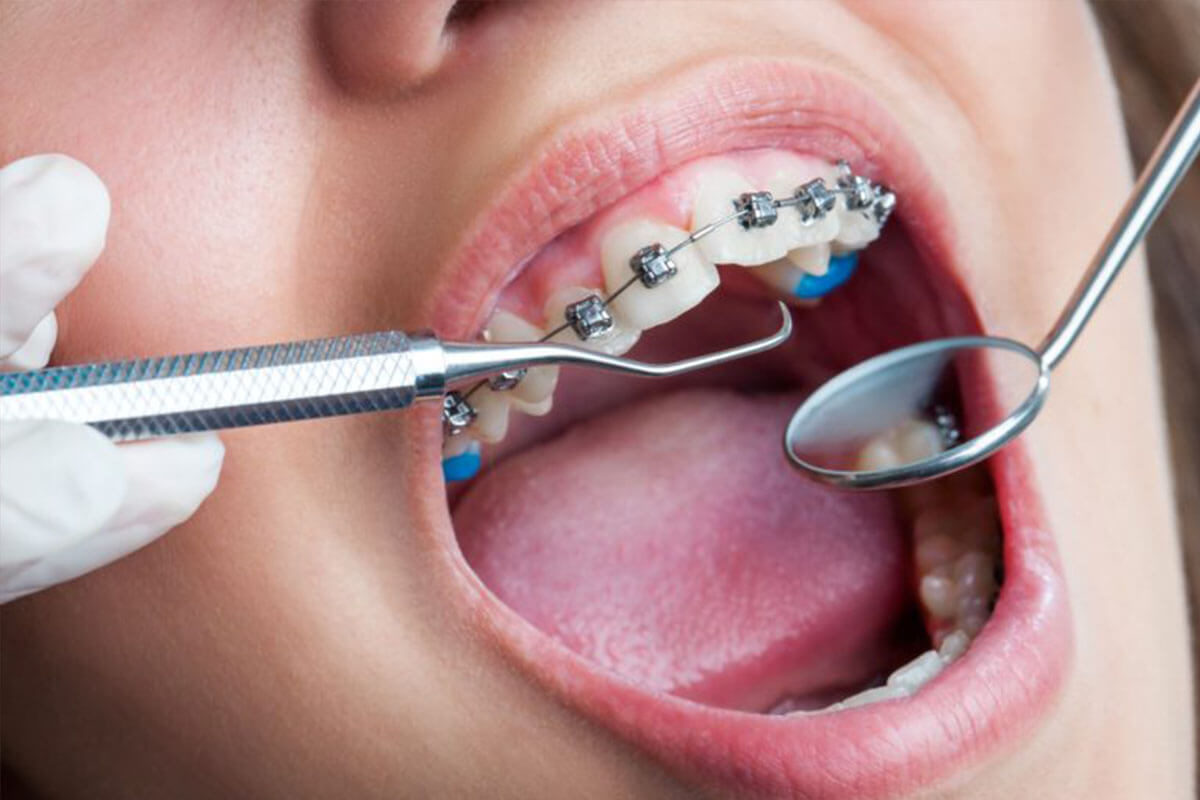 WHAT IS ORTHODONTIC TREATMENT